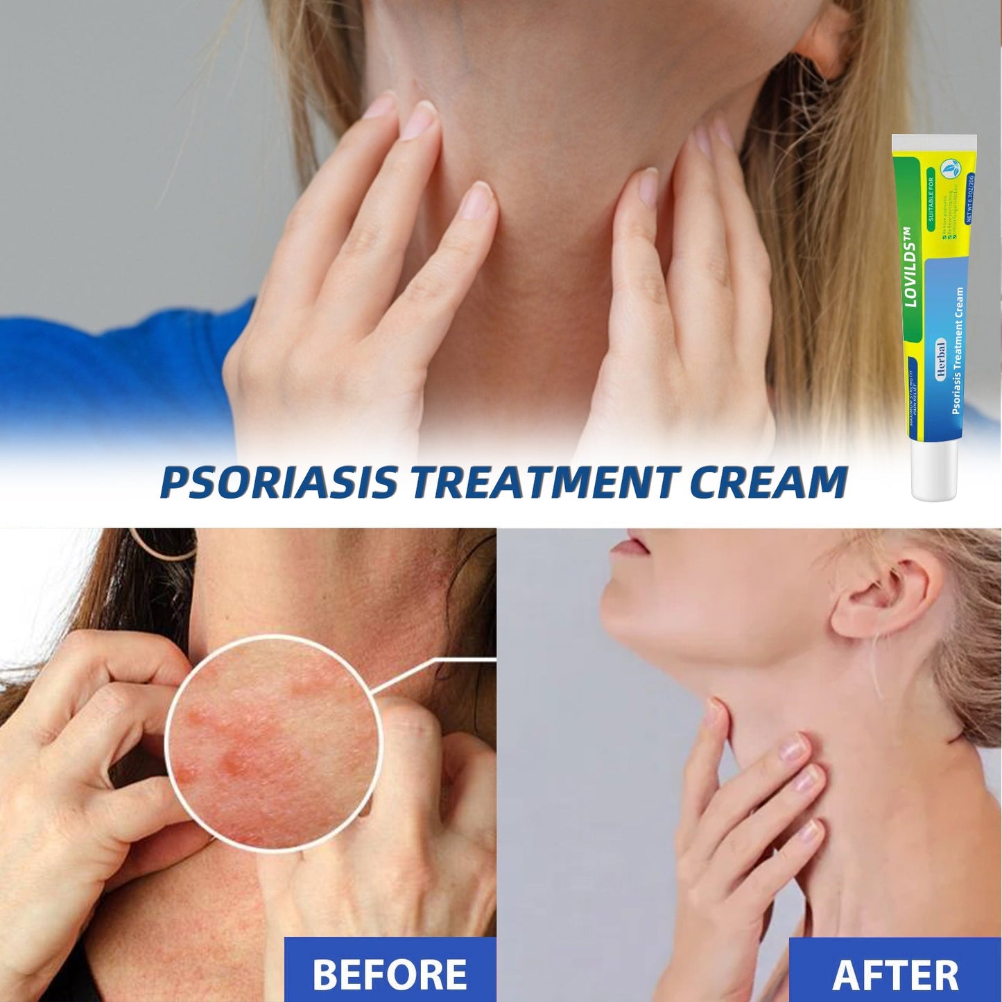 ļ¼š„Buy 2 Get 1 Freeš„ļ¼LOVILDSā¢Herbal Psoriasis Treatment Cream