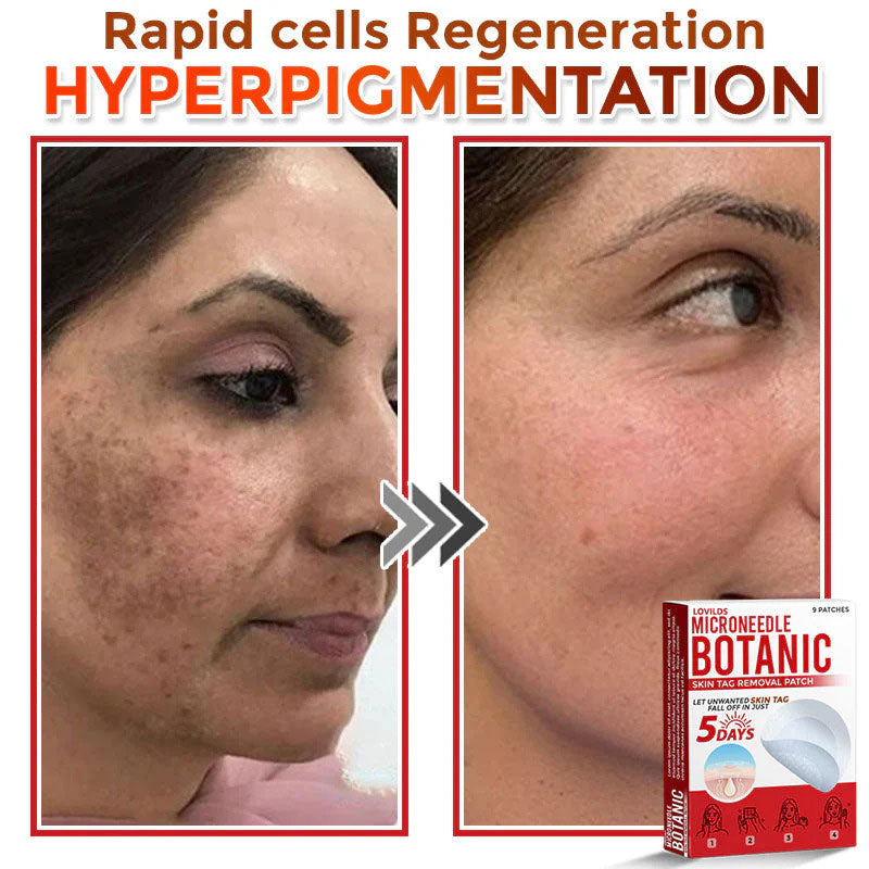 🌿 LOVILDS® MicroNeedle Skin Tag Removal Patch