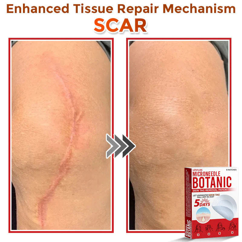 🌿 LOVILDS® MicroNeedle Skin Tag Removal Patch