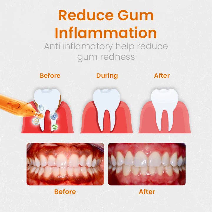 [Official Brand Store] LOVILDS™ Gum Repair Treatment Ampoules