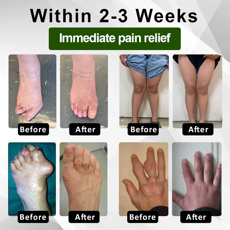 🔥LAST DAY SALE-80% OFF🔥 LOVILDS™ Emu Oil JointRelief Ointment