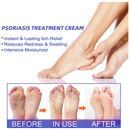 （🔥Buy 2 Get 1 Free🔥）LOVILDS™Herbal Psoriasis Treatment Cream