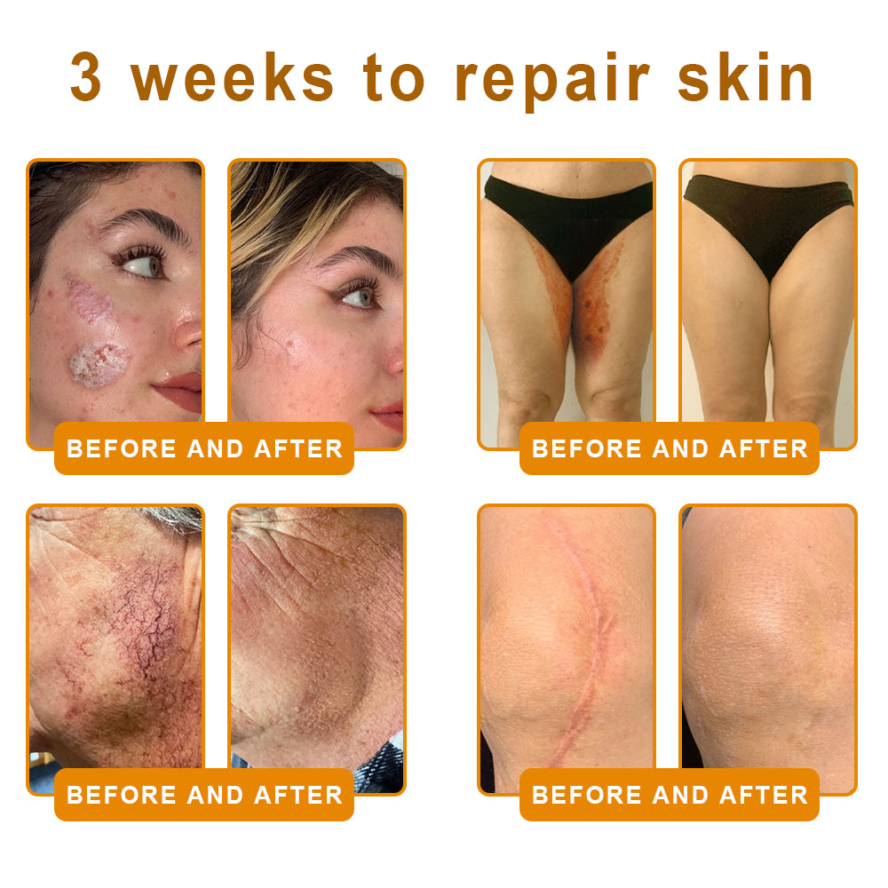 LOVILDS™ 𝘽𝙀𝙀 𝙑𝙀𝙉𝙊𝙈 𝑺𝒌𝒊𝒏 𝑹𝒆𝒔𝒕𝒐𝒓𝒂𝒕𝒊𝒐𝒏 𝑪𝒓𝒆𝒂𝒎 –🌸 Anti-aging,Hydrating, Skin Repair, Even Tone, Acne and Dark Spot Treatment, Wart and Mole Removal, Psoriasis Relief