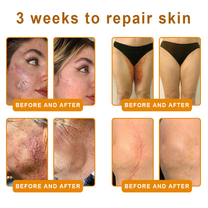 LOVILDS™ 𝘽𝙀𝙀 𝙑𝙀𝙉𝙊𝙈 𝑺𝒌𝒊𝒏 𝑹𝒆𝒔𝒕𝒐𝒓𝒂𝒕𝒊𝒐𝒏 𝑪𝒓𝒆𝒂𝒎 –🌸 Anti-aging,Hydrating, Skin Repair, Even Tone, Acne and Dark Spot Treatment, Wart and Mole Removal, Psoriasis Relief