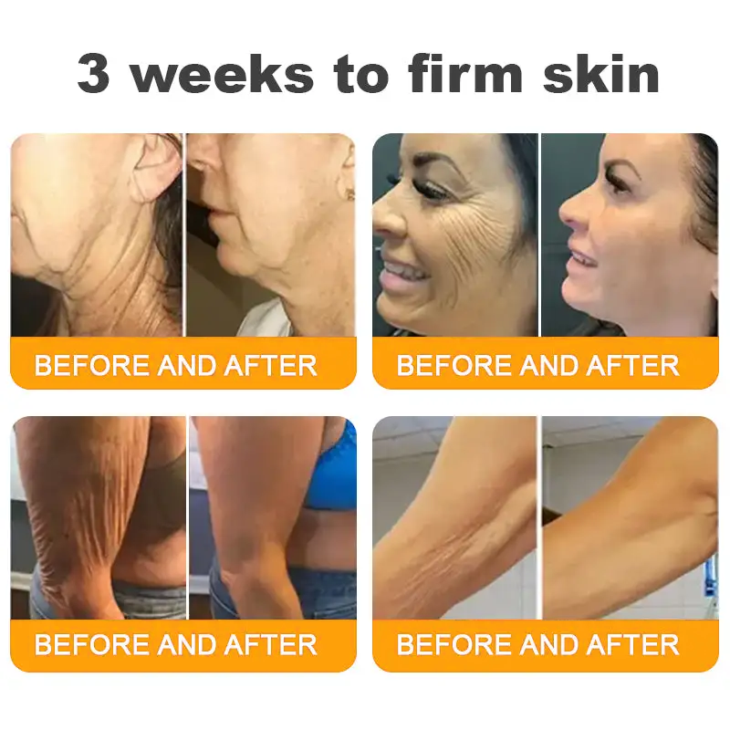 LOVILDS™ 𝘽𝙀𝙀 𝙑𝙀𝙉𝙊𝙈 𝑺𝒌𝒊𝒏 𝑹𝒆𝒔𝒕𝒐𝒓𝒂𝒕𝒊𝒐𝒏 𝑪𝒓𝒆𝒂𝒎 –🌸 Anti-aging,Hydrating, Skin Repair, Even Tone, Acne and Dark Spot Treatment, Wart and Mole Removal, Psoriasis Relief