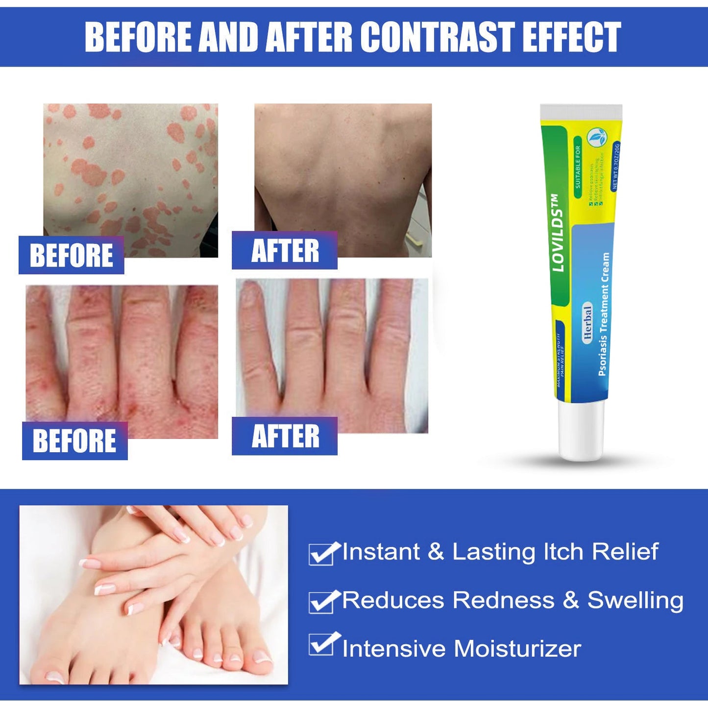 （🔥Buy 2 Get 1 Free🔥）LOVILDS™Herbal Psoriasis Treatment Cream