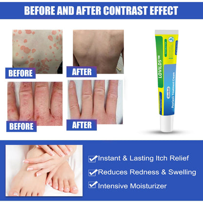 （🔥Buy 2 Get 1 Free🔥）LOVILDS™Herbal Psoriasis Treatment Cream