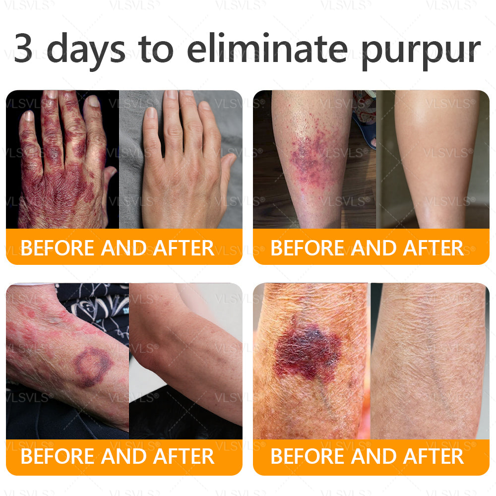 LOVILDS™ 𝘽𝙀𝙀 𝙑𝙀𝙉𝙊𝙈 𝑺𝒌𝒊𝒏 𝑹𝒆𝒔𝒕𝒐𝒓𝒂𝒕𝒊𝒐𝒏 𝑪𝒓𝒆𝒂𝒎 –🌸 Anti-aging,Hydrating, Skin Repair, Even Tone, Acne and Dark Spot Treatment, Wart and Mole Removal, Psoriasis Relief