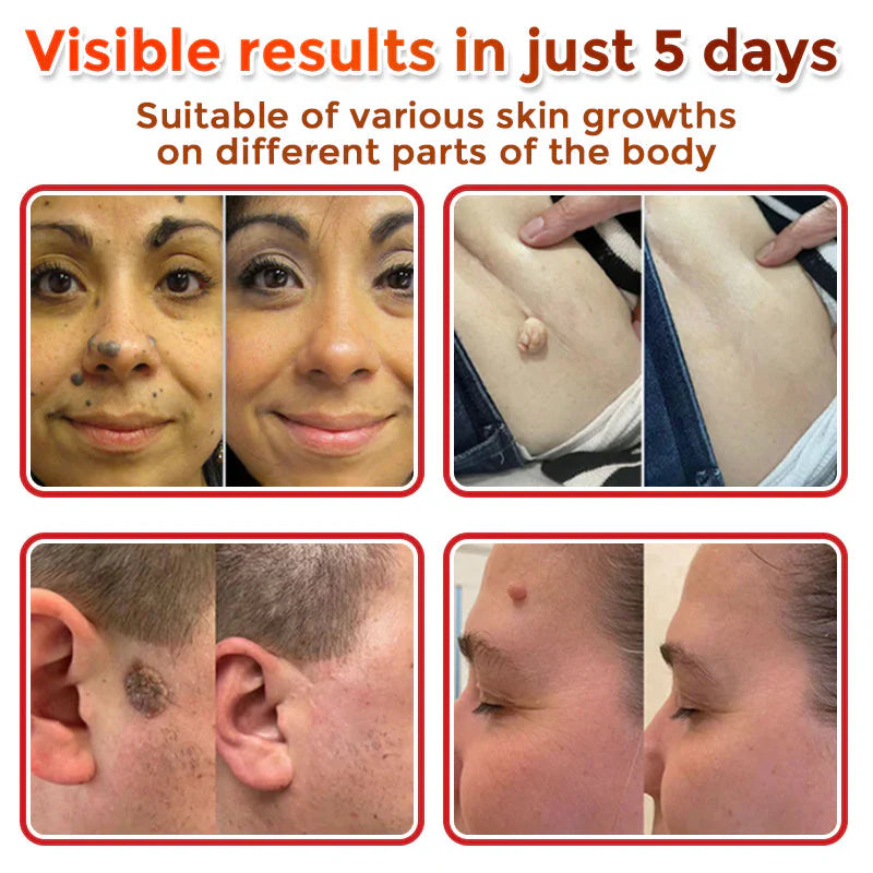 🌿 LOVILDS® MicroNeedle Skin Tag Removal Patch