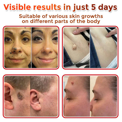 🌿 LOVILDS® MicroNeedle Skin Tag Removal Patch