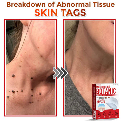 🌿 LOVILDS® MicroNeedle Skin Tag Removal Patch