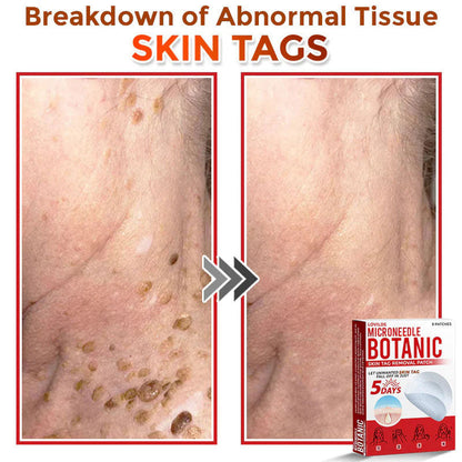 🌿 LOVILDS® MicroNeedle Skin Tag Removal Patch