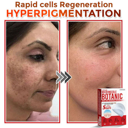 🌿 LOVILDS® MicroNeedle Skin Tag Removal Patch