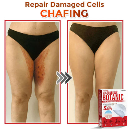 🌿 LOVILDS® MicroNeedle Skin Tag Removal Patch