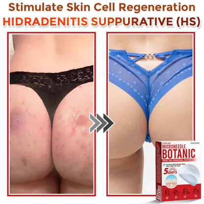 🌿 LOVILDS® MicroNeedle Skin Tag Removal Patch