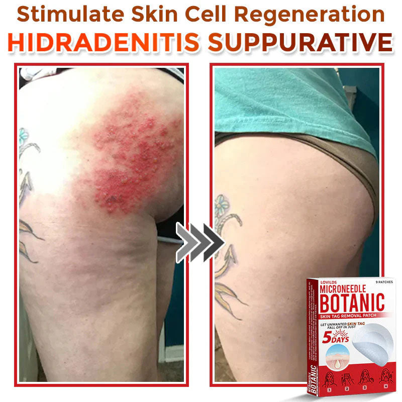 🌿 LOVILDS® MicroNeedle Skin Tag Removal Patch