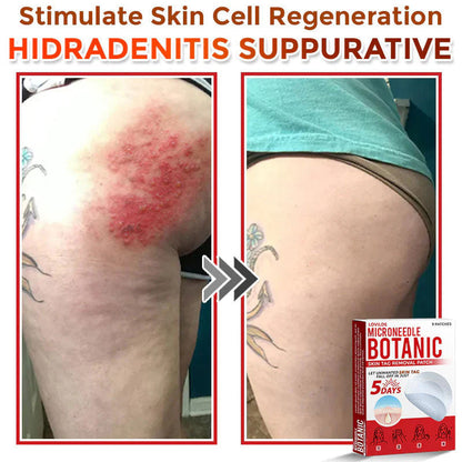 🌿 LOVILDS® MicroNeedle Skin Tag Removal Patch
